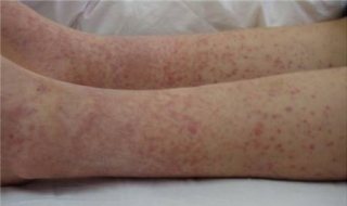 过敏性紫癜不能吃什么（过敏性紫癜不能吃什么肉）