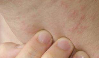 湿疹怎么治（湿疹怎么治疗方法）