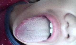 艾滋病症状图片（艾滋病症状图片男性）