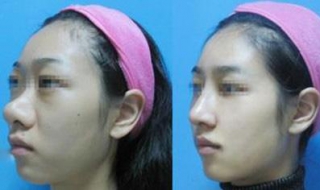 缩小鼻翼的方法 缩小鼻翼的方法有哪些按摩