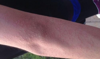 荨麻疹怎么样治疗（荨麻疹怎么样治疗除根）