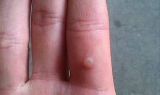 鸡眼怎么治（鸡眼怎么治能彻底根除图片）