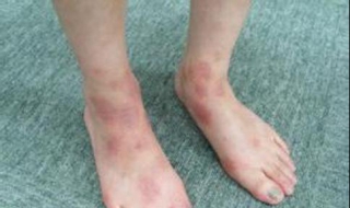 湿疹怎么引起的（什么叫湿疹是什么原因引起的）