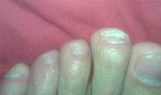 灰指甲图片 灰指甲图片早期图片 轻微