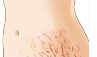 妊娠纹消除方法（妊娠纹消除方法有哪些）