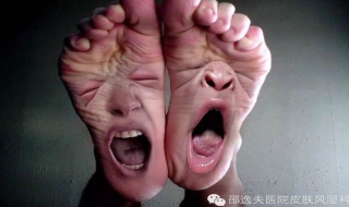 脚气怎么治（脚气怎么治疗用什么药）