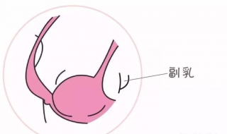 副乳是什么 副乳是什么样子的图片