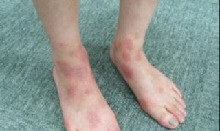 湿疹怎么引起的（湿疹怎么引起的多久才能好）