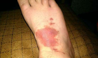 过敏性紫癜不能吃什么 过敏性紫癜不能吃什么调料