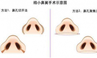 缩小鼻翼的方法（缩小鼻翼的方法有哪些）