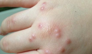 荨麻疹怎么样治疗（荨麻疹吃什么药最有效）