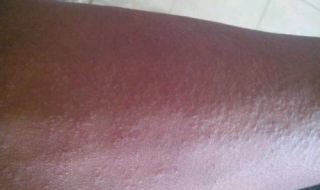 皮肤容易过敏怎么办（婴儿皮肤容易过敏怎么办）