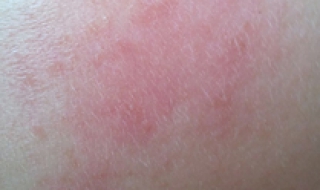 春天脸上过敏怎么办（春天脸上过敏怎么办小妙招）