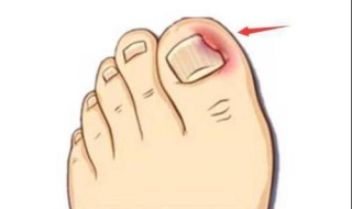指甲长到肉里怎么办（大脚趾指甲长到肉里怎么办）
