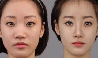 鼻翼肥大怎么办 鼻翼肥大是什么原因导致的