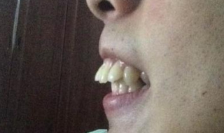 龅牙怎么办（龅牙怎么矫正）