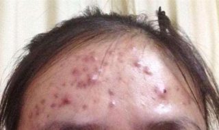 额头的痘痘怎么办（额头痘痘怎么办才能消下去）