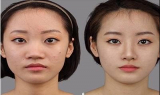 蒜头鼻怎么办 蒜头鼻怎么改善
