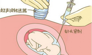 羊水穿刺怎么做（羊水穿刺怎么做的图片）