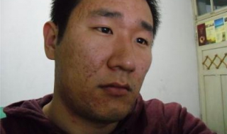 青春痘疤痕怎么办 青春痘疤痕修复怎么办