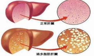 轻度脂肪肝怎么办（有轻度脂肪肝怎么办）