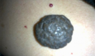 黑色素瘤和痣的区别 黑色素瘤和痣的区别是啥