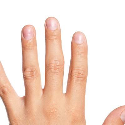 冻疮是怎么形成的 冻疮是怎么形成的?