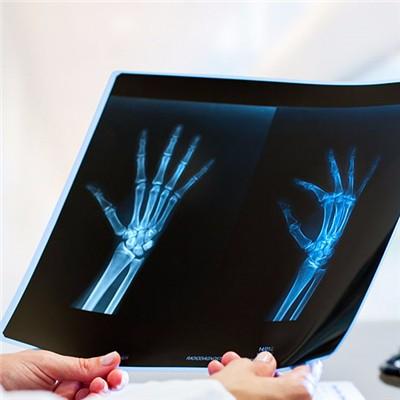 骨质增生是什么意思 腰椎轻度骨质增生是什么意思