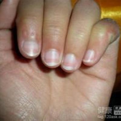 真菌感染怎么办 下体真菌感染怎么办