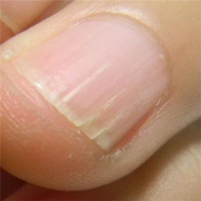 手指甲裂口怎么办 手指甲裂口怎么办小妙招