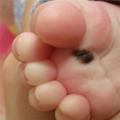 亚洲人脚底的痣容易恶变吗 脚哪里有痣容易恶变