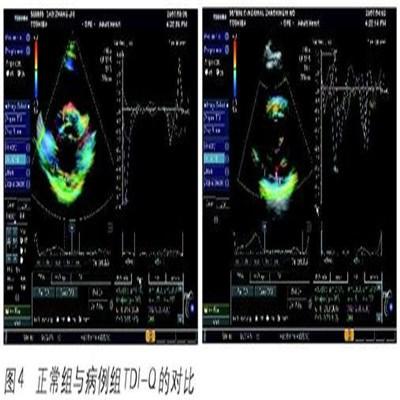 左心室舒张功能减低怎么办（右心室舒张功能减低如何治疗）