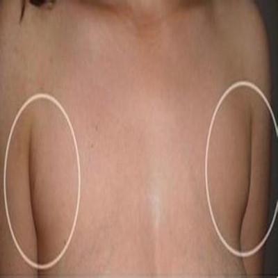 副乳怎么解决（副乳应该怎么消除）