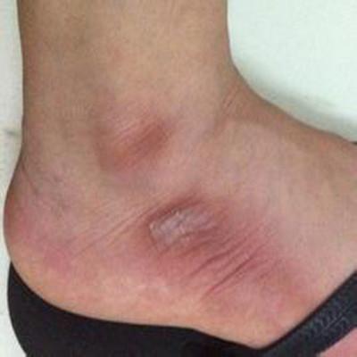 脚踝处皮肤变黑怎么办 脚踝上的皮肤变黑是什么原因