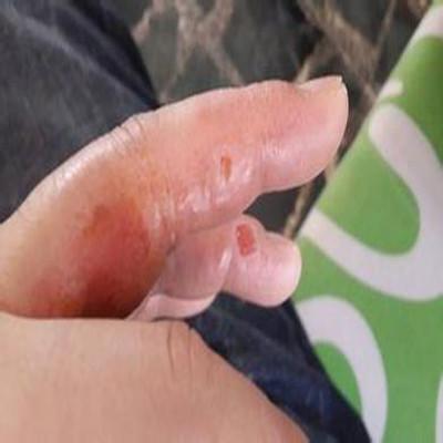 手廯怎么办 手偆了怎么办