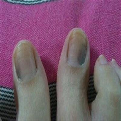 脚趾甲发黑怎么办 儿童脚趾甲发黑怎么办