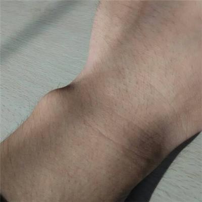 手腕处有个骨头突出怎么办（手腕上有个骨头突出）