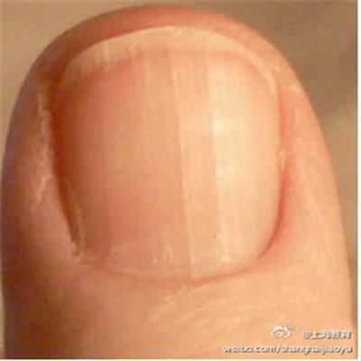 手指甲脆是什么原因（手指甲脆是什么原因导致的）