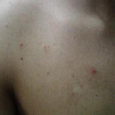 药物过敏皮疹怎么治（药物过敏皮疹怎么治好）
