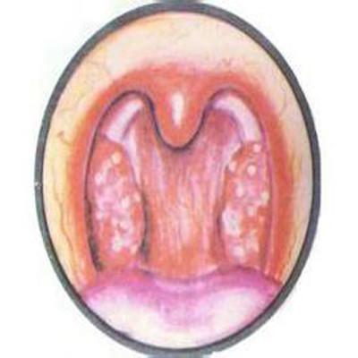 扁桃体化脓多久能好（孩子急性扁桃体化脓多久能好）