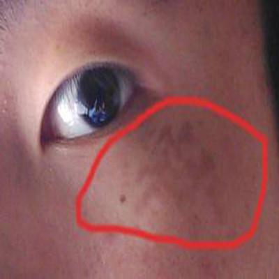 男人眼角长斑的原因有哪些 男人眼角长斑什么原因