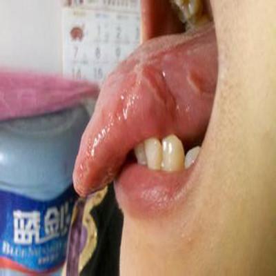 舌头边缘有白色块状物是什么（舌头边缘有白色块状物是什么原因）