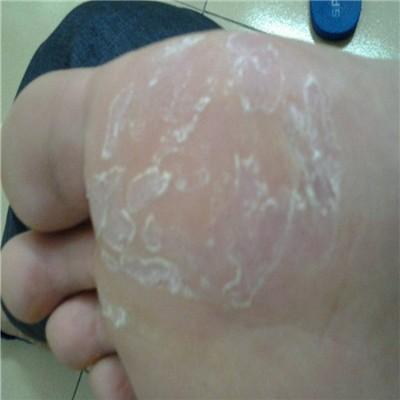脚底脱皮是什么原因（脚底脱皮是什么原因导致的）