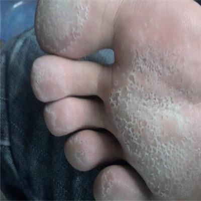 脚底脱皮是什么原因（脚底脱皮是什么原因不痒）
