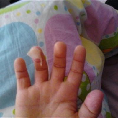 儿童手指头脱皮怎么办（儿童手指头脱皮怎么办?如何正确解决?）