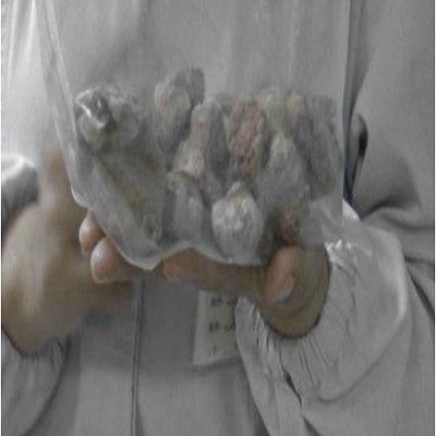 肾窦管壁结晶附着怎么办 肾小管结晶沉积