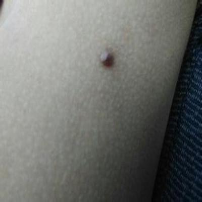 身上小肉丁怎么治（身上多余的小肉丁怎么去除）