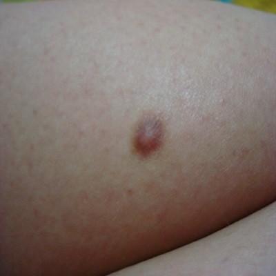 腿上有个硬疙瘩 腿上有个硬疙瘩一按就疼