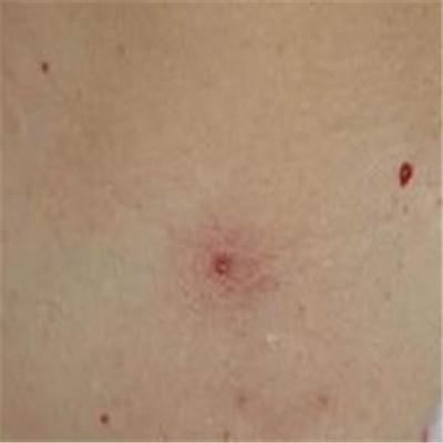 蜘蛛痣图片是什么样的 蜘蛛痣长啥样子
