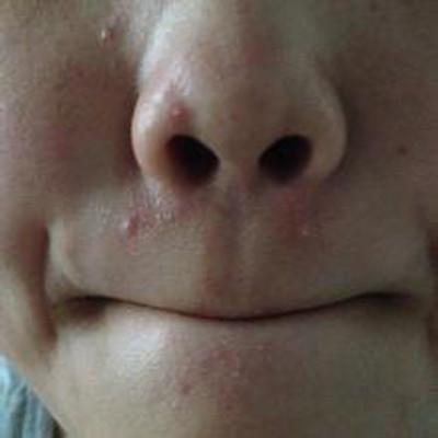 痘痘里面挤出来的白色东西是什么 痘痘里面挤出来的白色米粒